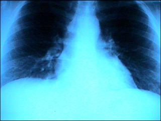 Lung X-ray