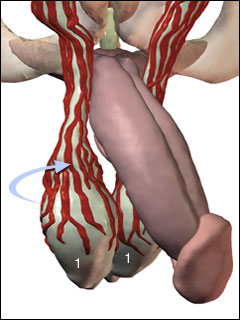 Testicular torsion