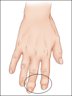 Osteoarthritis of the finger joint