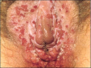 Genital sores (female)