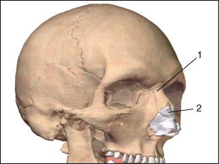 Nasal fracture