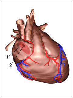 Atrial septal defect