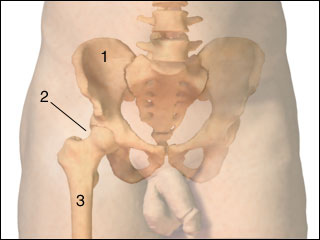 Congenital dislocation of the hip
