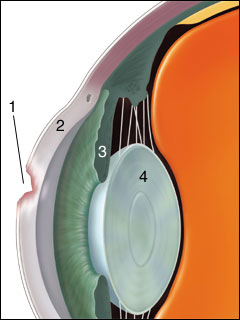 Corneal injury