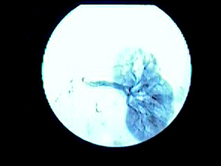 Renal arteriography