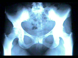 Pelvis X-ray