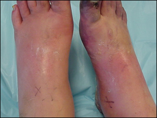 Cellulitis