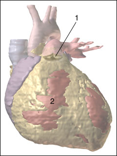 Pulmonary valve narrowing (stenosis)