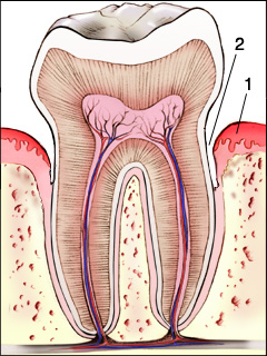 Gingivitis