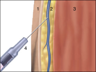 Injecting a substance into the vein
