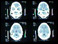 Cranial CT