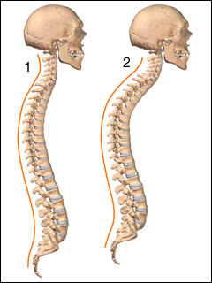 Kyphosis