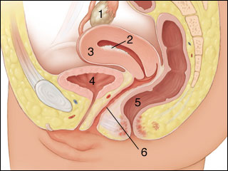 Endometrial cancer