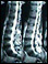 Lumbosacral spine MRI
