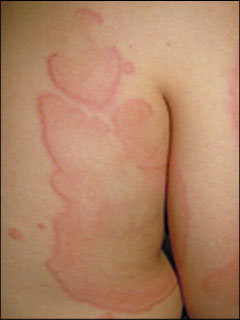 Urticaria pigmentosa