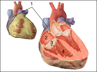 Tricuspid Atresia