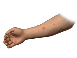 Allergy testing with positive skin tests