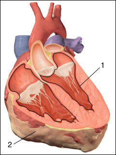 Infection of the lining of the inside of the heart (endocarditis)