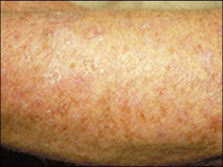 Actinic keratosis (on arm)