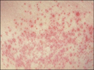 Candidiasis of the skin