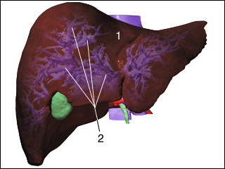 Hepatic vein blockage