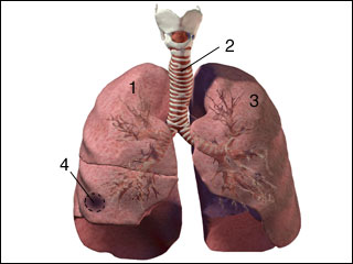 Lung abscess