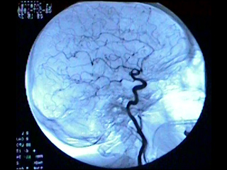 Cerebral arteriography