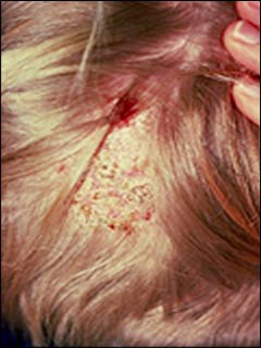 how to diagnose scalp ringworm