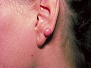 Keloid