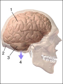 Brain herniation