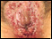 Genital sores (female)