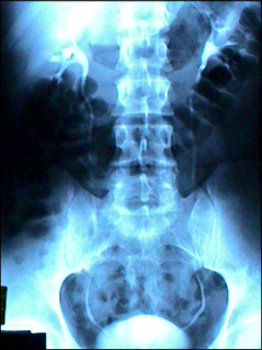 Kidney X-ray