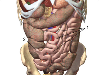 Meckel's diverticulum