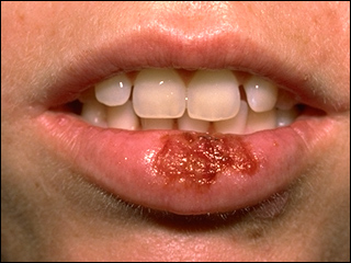 Oral herpes