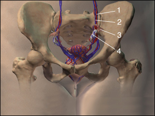 Right ovarian vein syndrome