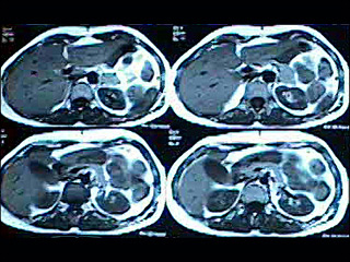 Abdominal MRI