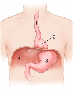 Hiatal hernia