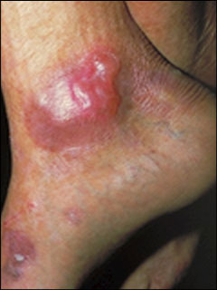 Epidermolysis bullosa