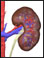 Kidney stones (nephrolithiasis)