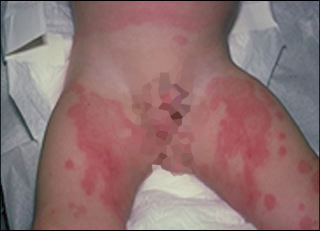 Erythema multiforme