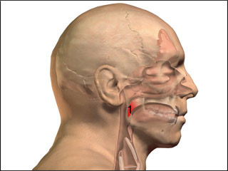 Inflammation of the Uvula