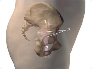 Retroversion of the uterus