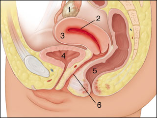 Endometriosis