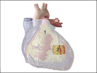 Inflammation of the heart sac (pericarditis)