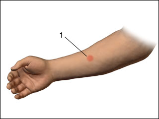 Tuberculosis positive skin test