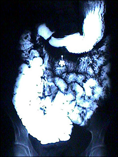 Upper GI and small bowel series