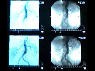 Aortic angiogram