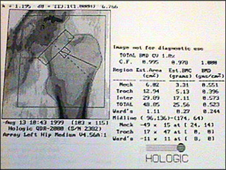 Osteoporosis (bone thinning) as seen on a bone scan