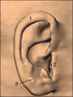 Benign ear cyst or tumor