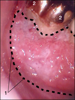 Mouth cancer